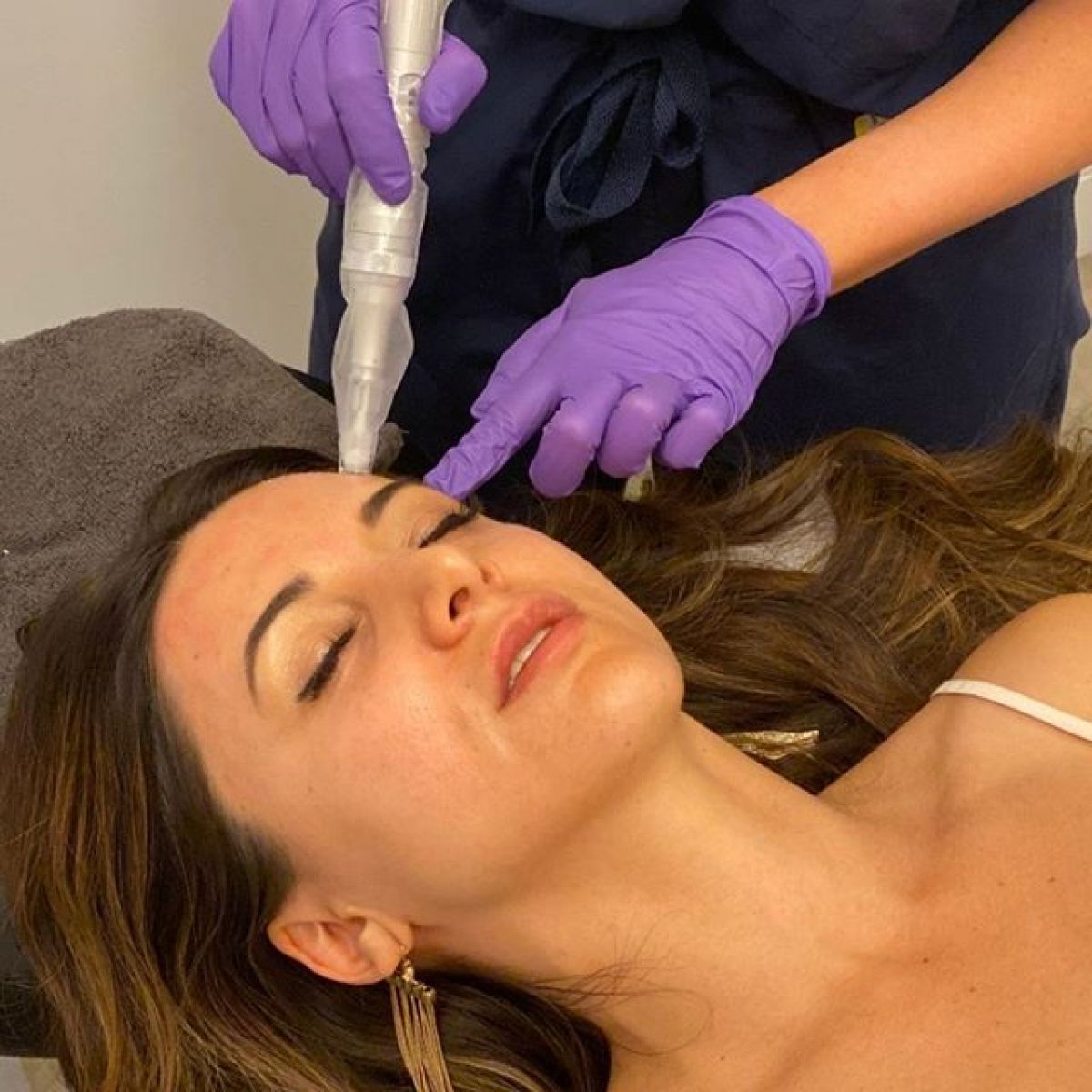 MicroNeedling BB Glow à Schiltigheim (67) Par Adeline - Estheca
