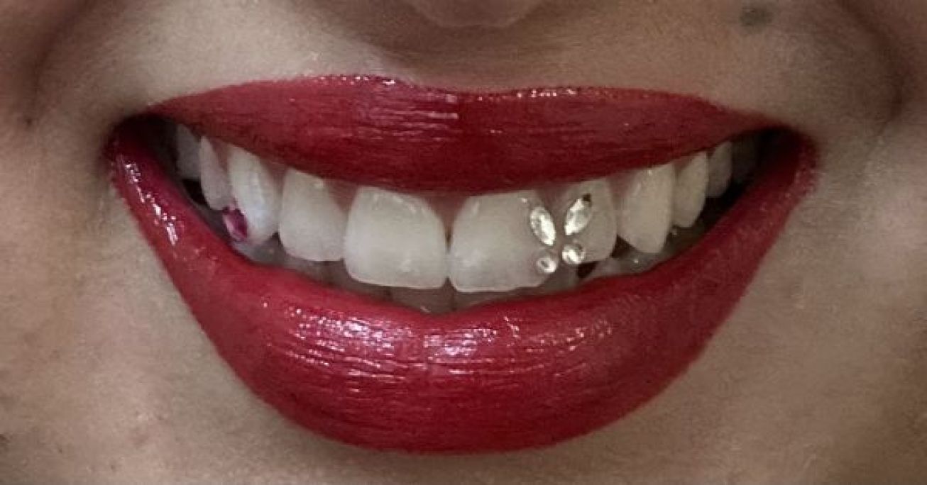 Strass dentaire à Noisy-le-Grand (93) Par Kenza - Estheca