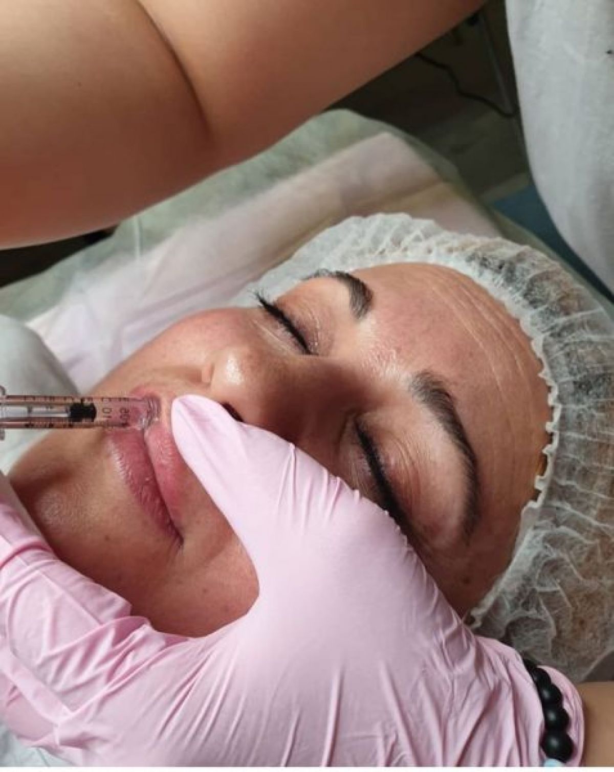 Hyaluronpen à Paris (75) Par Emma - Estheca
