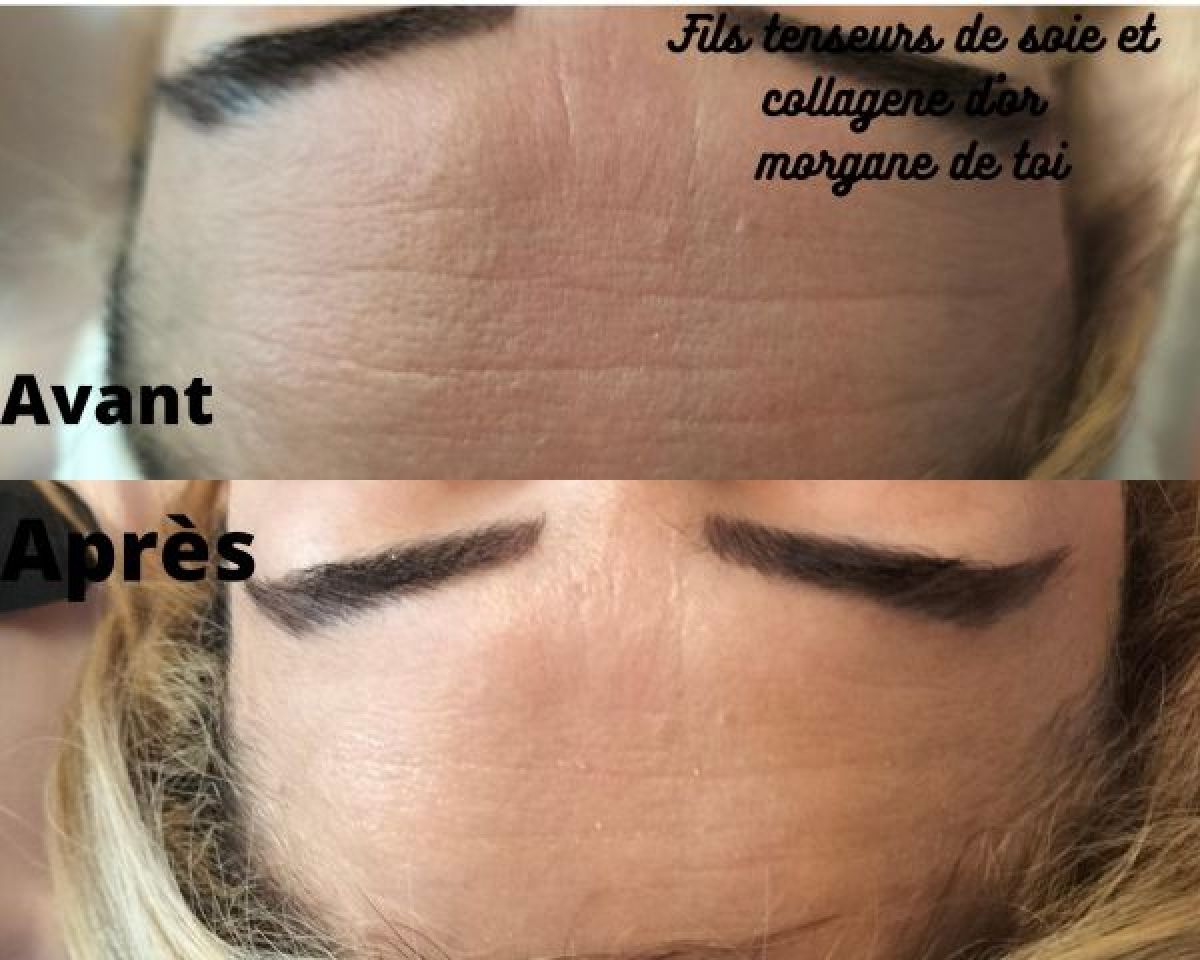 Lifting fil de soie et collagene d'or à Frangy (74) Par Morgane - Estheca