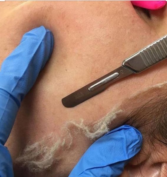 À Kingersheim | Dermaplaning | Les meilleures esthéticiennes