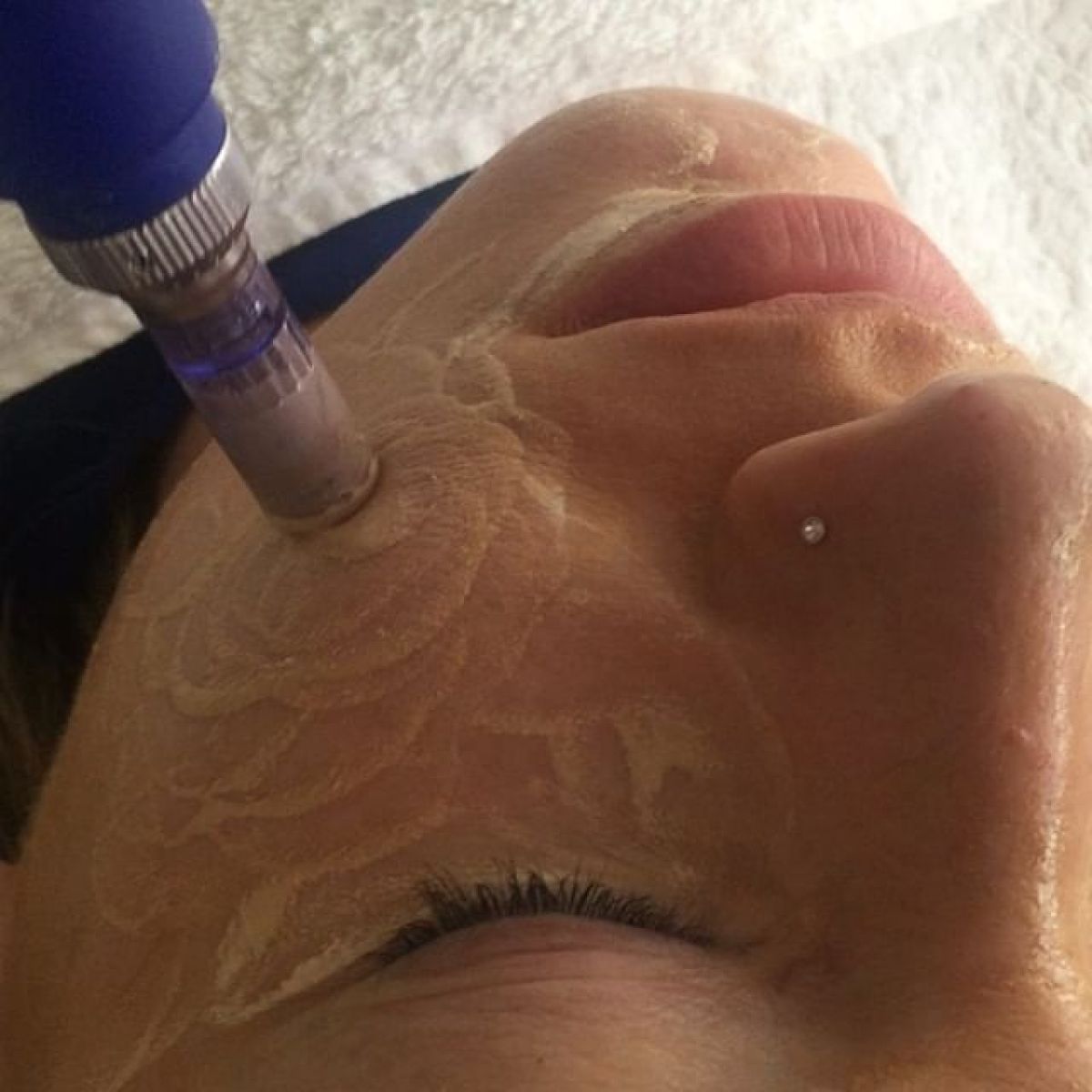 MicroNeedling BB Glow à Bagneux (92) Par Pauline - Estheca