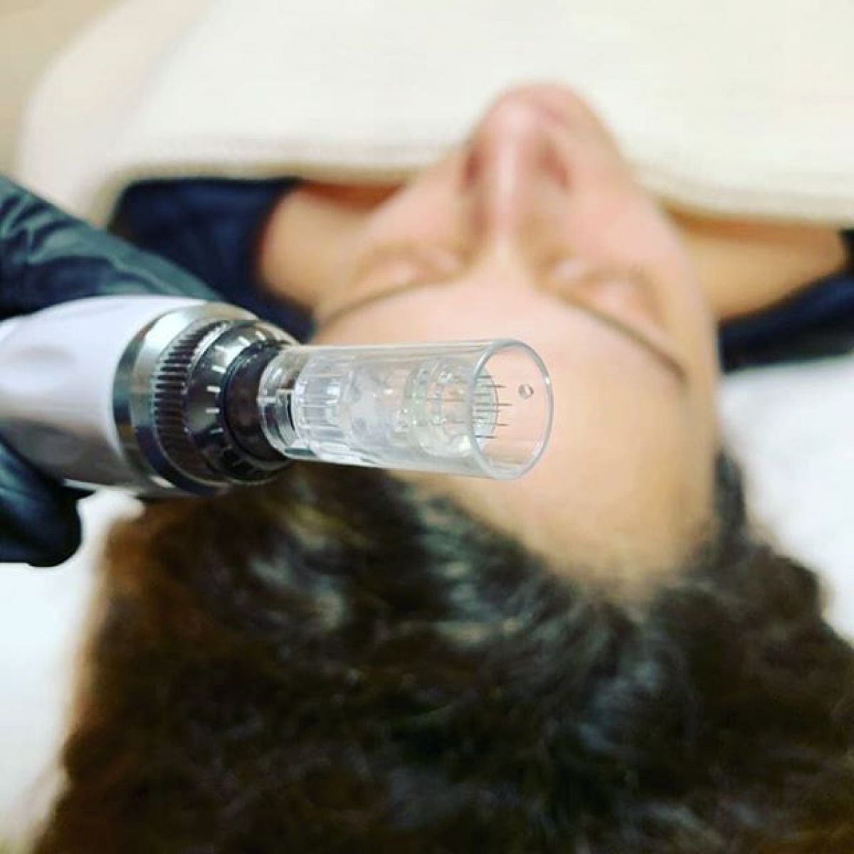 MicroNeedling BB Glow à Neuilly-sur-Marne (93) Par Léa - Estheca