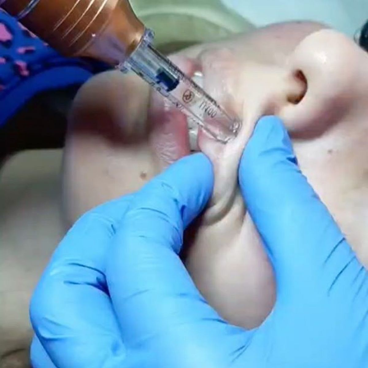 Hyaluron pen lèvres et rides à Sevran (93) Par Caroline - Estheca