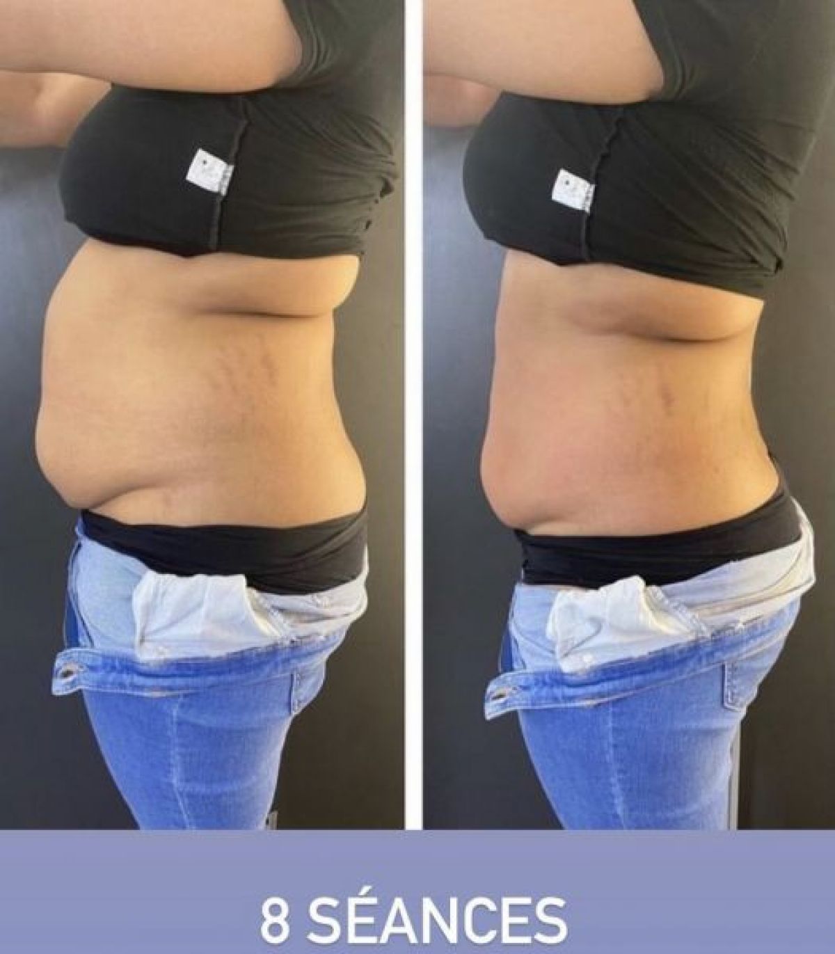 Amincissement, lipocavitation radiofrequence lipolaser à Reims (51) Par Mery - Estheca