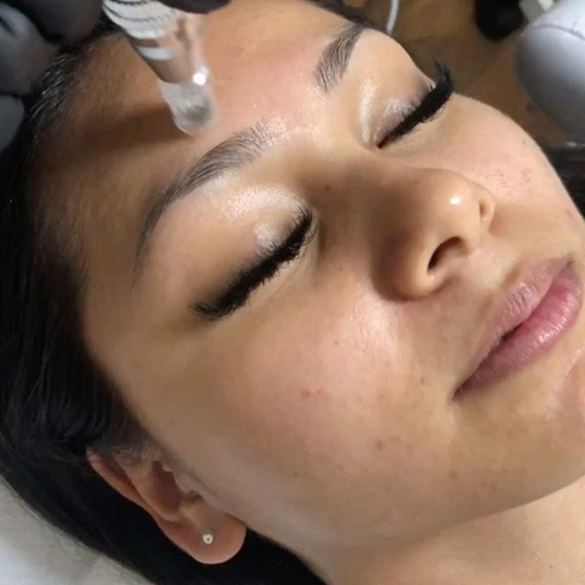 MicroNeedling BB Glow à Fontenay-sous-Bois (94) Par Sabrina - Estheca