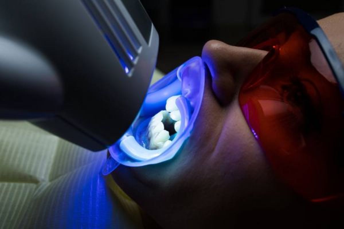 Blanchiment dentaire à Montpellier (34) Par Kadija - Estheca