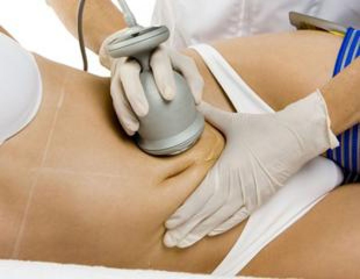 Radio fréquence et Lipocavitation à Paris (75) Par Dolly - Estheca