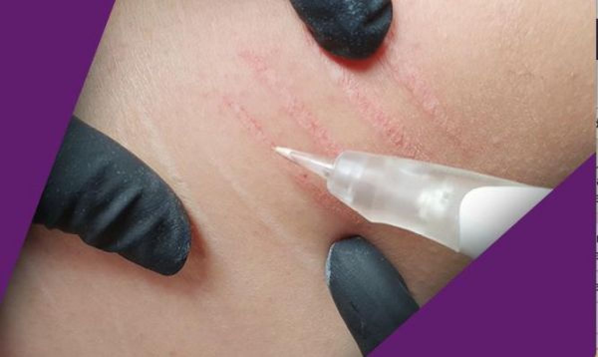 Maquillage permanent vergetures, aréole mammaire, cicatrices à Nantes (44) Par Aurélie - Estheca