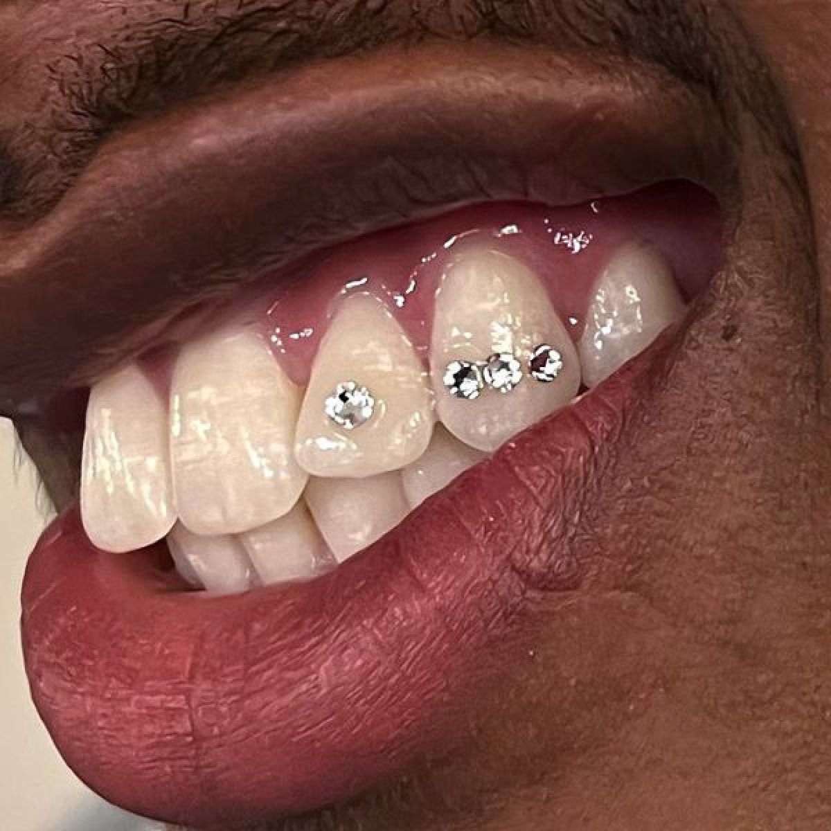 Strass  dentaires à Melun (77) Par Melissa - Estheca