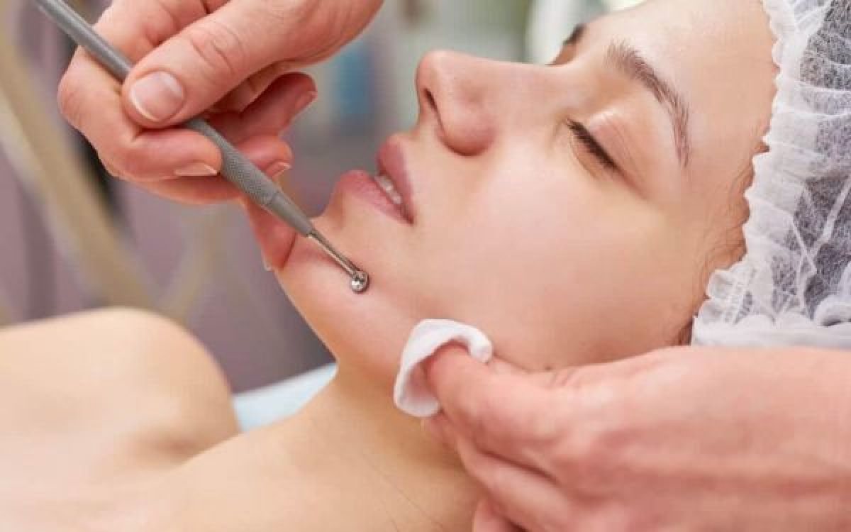 Extraction points noirs à Saint-Martin-d'Hères (38) Par Sabrina - Estheca