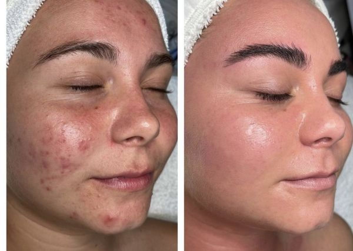 Microneedling BB GLOW à Montpellier (34) Par Manare - Estheca