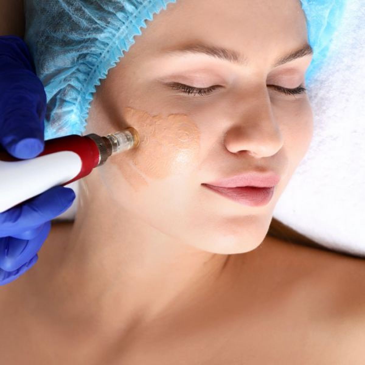 Microneedling BB GLOW à Nancy (54) Par Kristelle - Estheca
