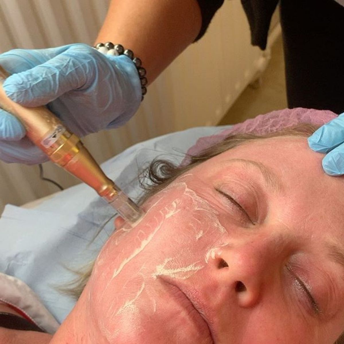MicroNeedling BB Glow à Savigny-sur-Orge (91) Par Virginie - Estheca