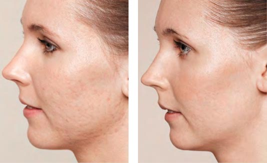 MicroNeedling: Le traitement visage révolutionnaire!