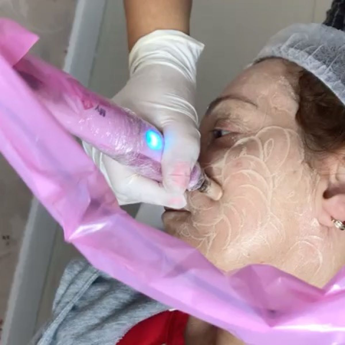 MicroNeedling BB Glow à Corbeil-Essonnes (91) Par Manel - Estheca