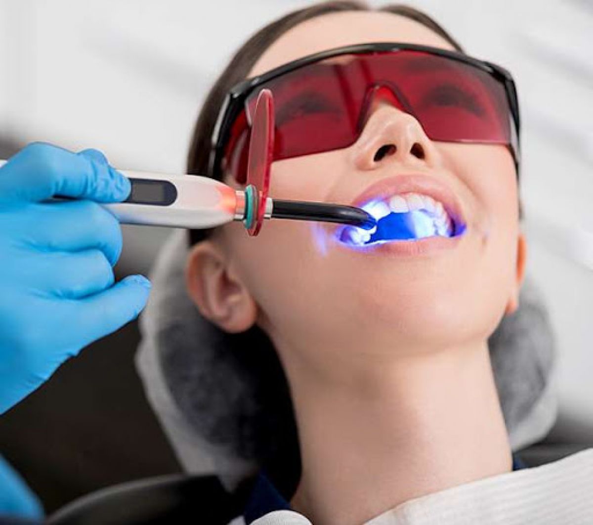 Blanchiment dentaire à Chalon-sur-Saône (71) Par Chloé - Estheca