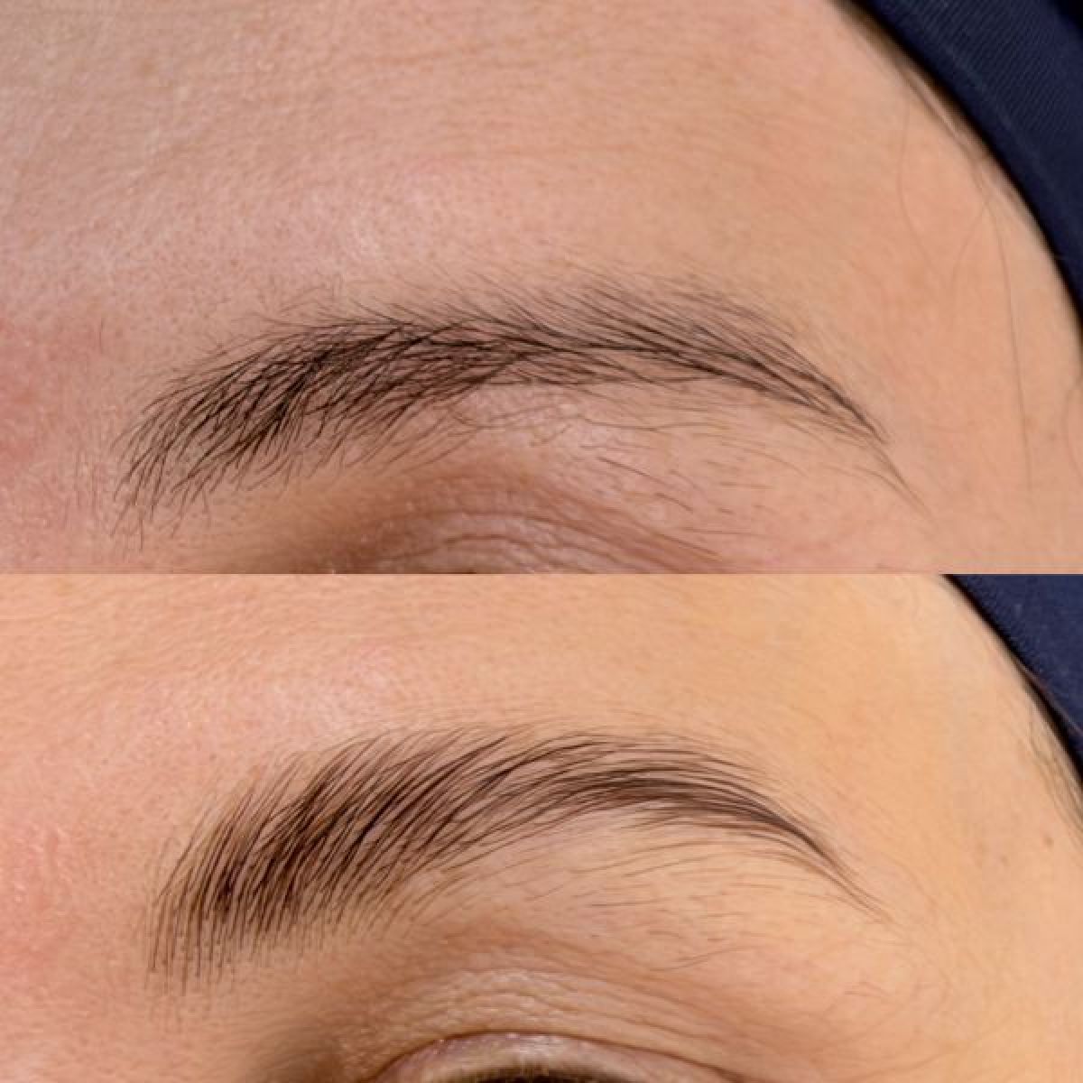 Brow lift (rehaussement de sourcils) à Argenteuil (95) Par Laetitia - Estheca