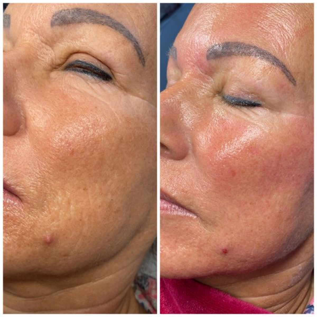 Hyalnano Filling ( anti-âge ) à Saint-Louis (68) Par Laëtitia - Estheca