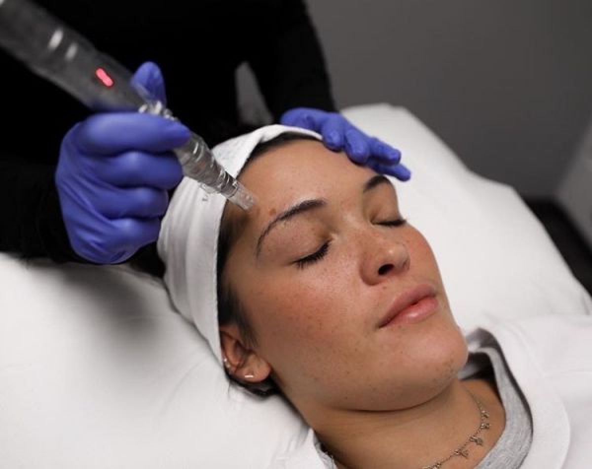 MicroNeedling BB Glow à Strasbourg (67) Par Maya - Estheca