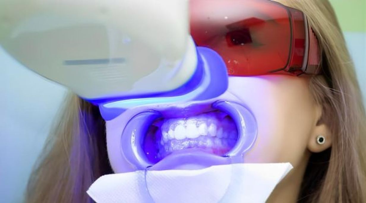 Blanchiment dentaire américain à Pontault-Combault (77) Par Camila - Estheca