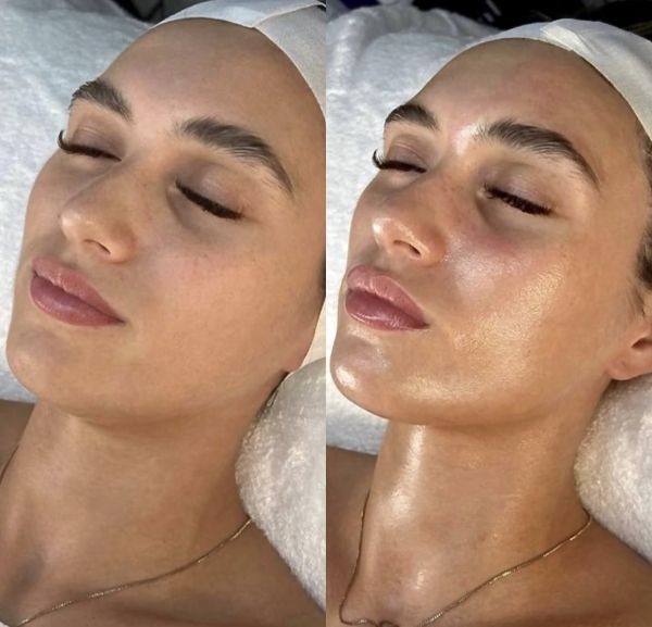 À Nice | Hydrafacial | Les meilleures esthéticiennes