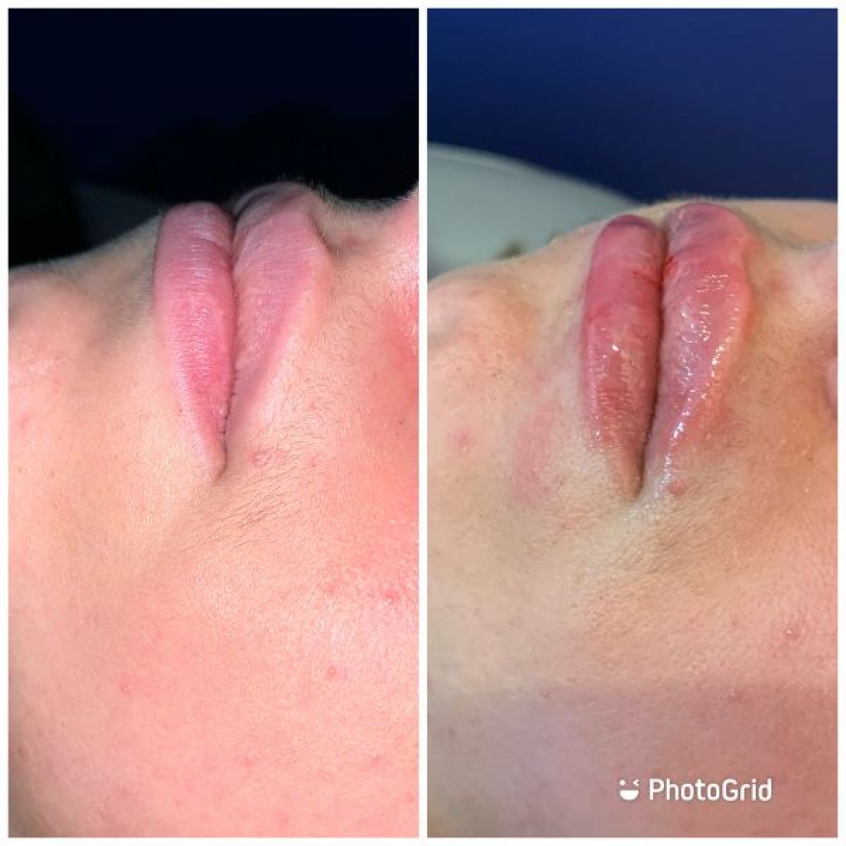 Hyaluron pen (gonflement des lèvres ,comblement des rides à Amiens (80) Par Emilie - Estheca