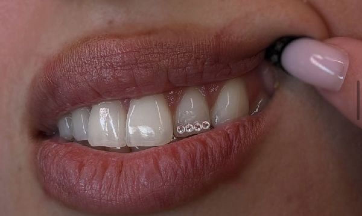 Strass dentaire à Bordeaux (33) Par Fatima - Estheca