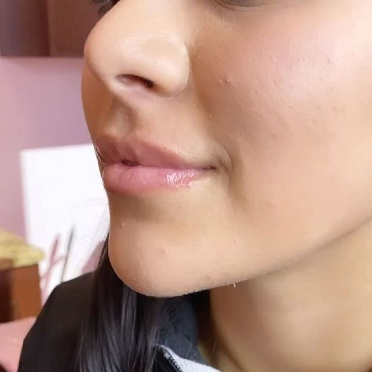 Hyaluron pen à Plaisance-du-Touch (31) Par Mathilde - Estheca