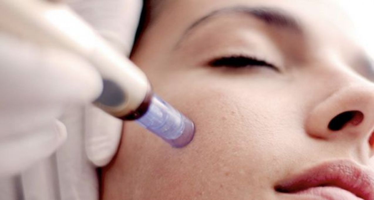 Microneedling à Chambéry (73) Par Gulcan - Estheca