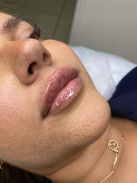 À Metz | Hyaluron pen | Les meilleures esthéticiennes