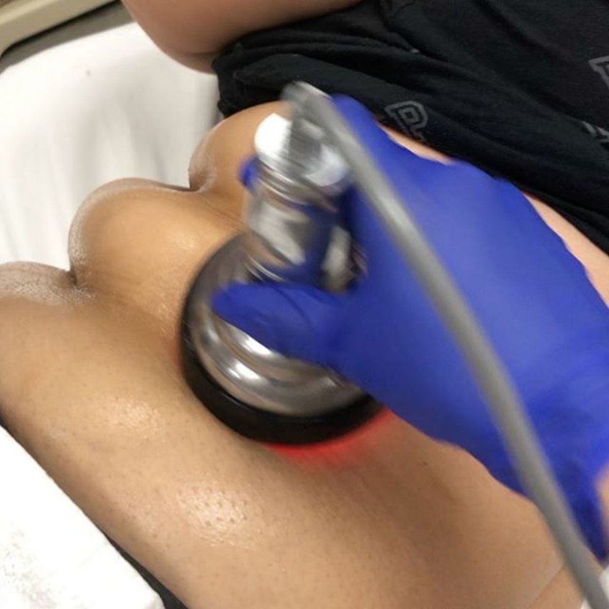 Radio fréquence - Lipocavitation à Rezé (44) Par Mélody - Estheca