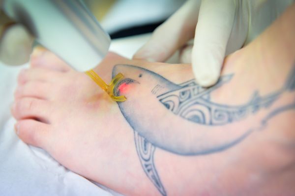 À Limoges | Détatouage laser | Les meilleures esthéticiennes