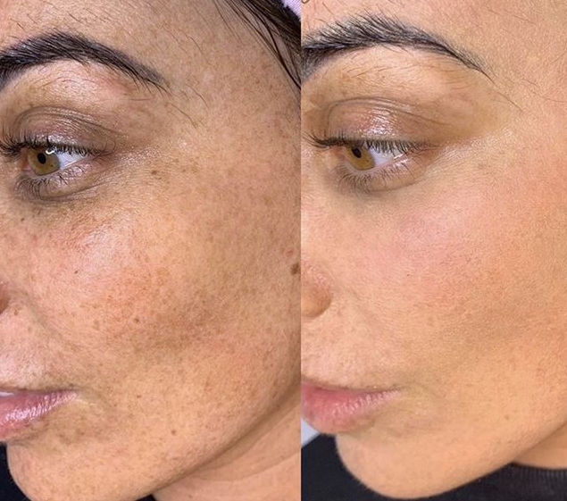 À Dax | Microneedling (traces d'acné, imperfections...) | Les meilleures esthéticiennes