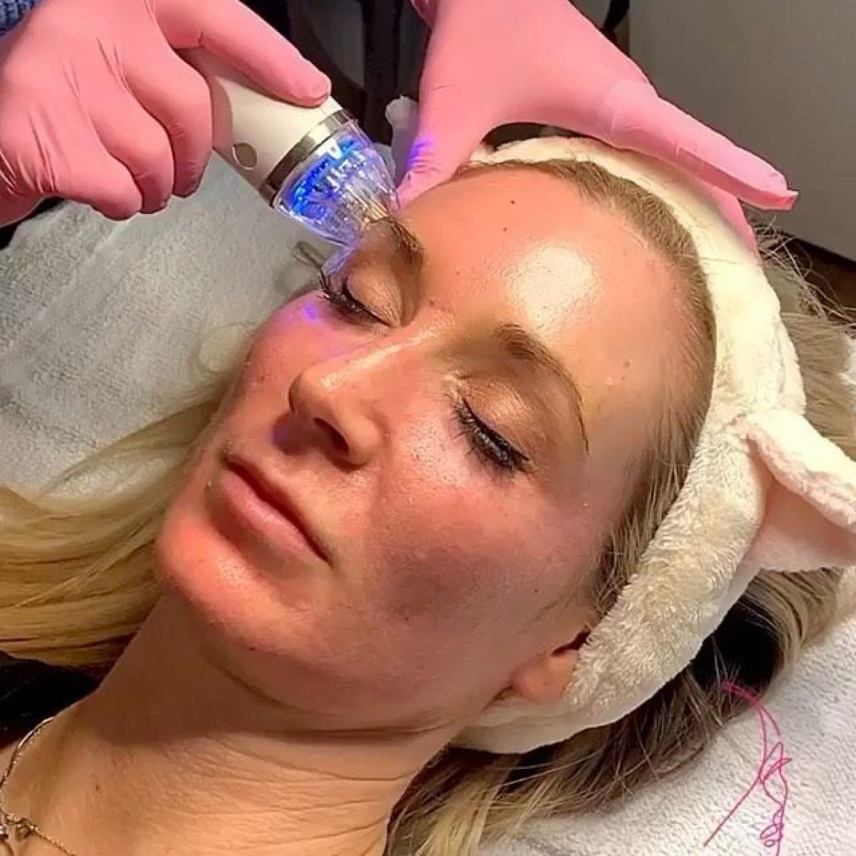MicroNeedling BB Glow à Villenave-d'Ornon (33) Par Laetitia - Estheca