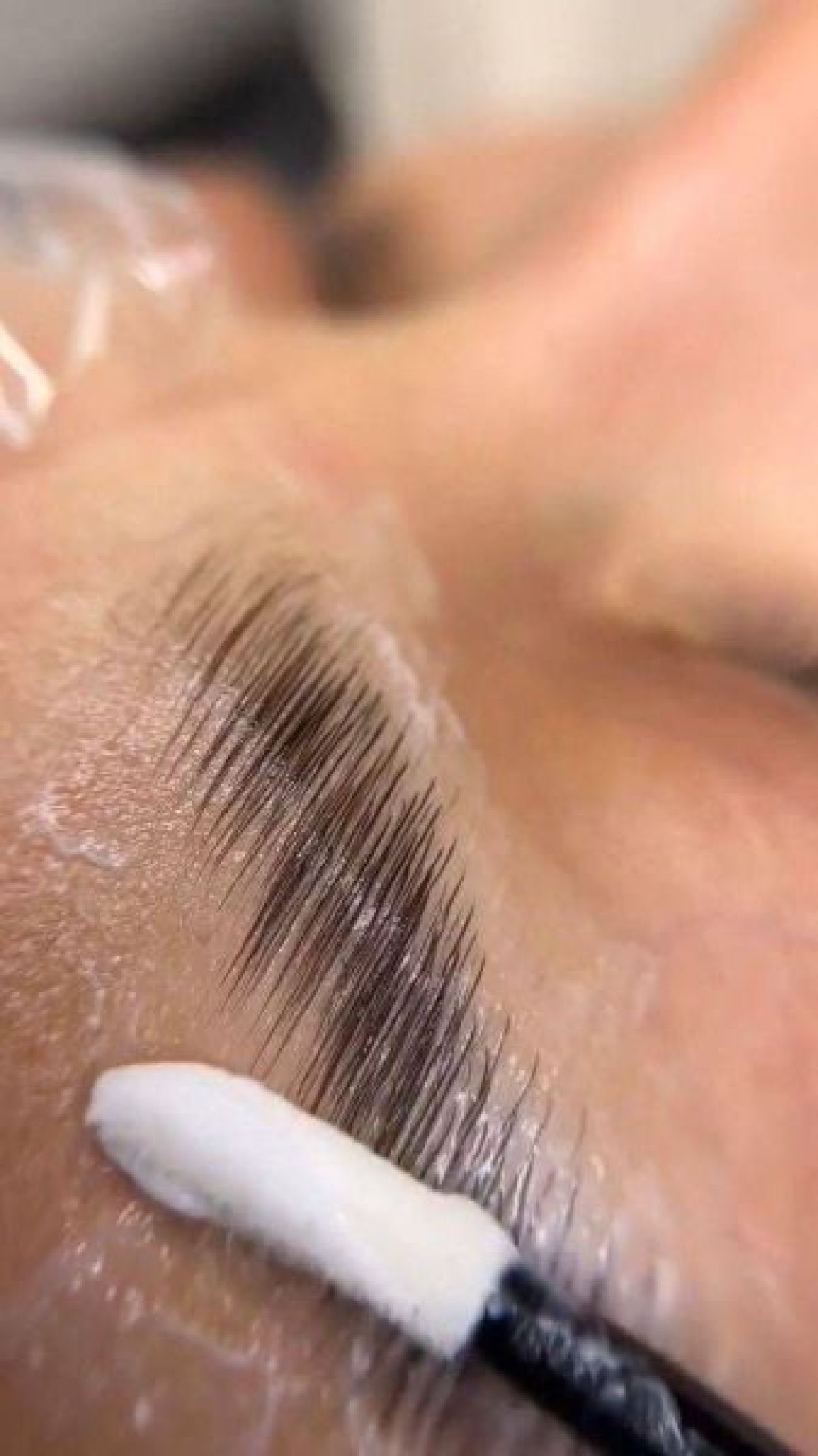 Brow lift à Strasbourg (67) Par Lobna - Estheca