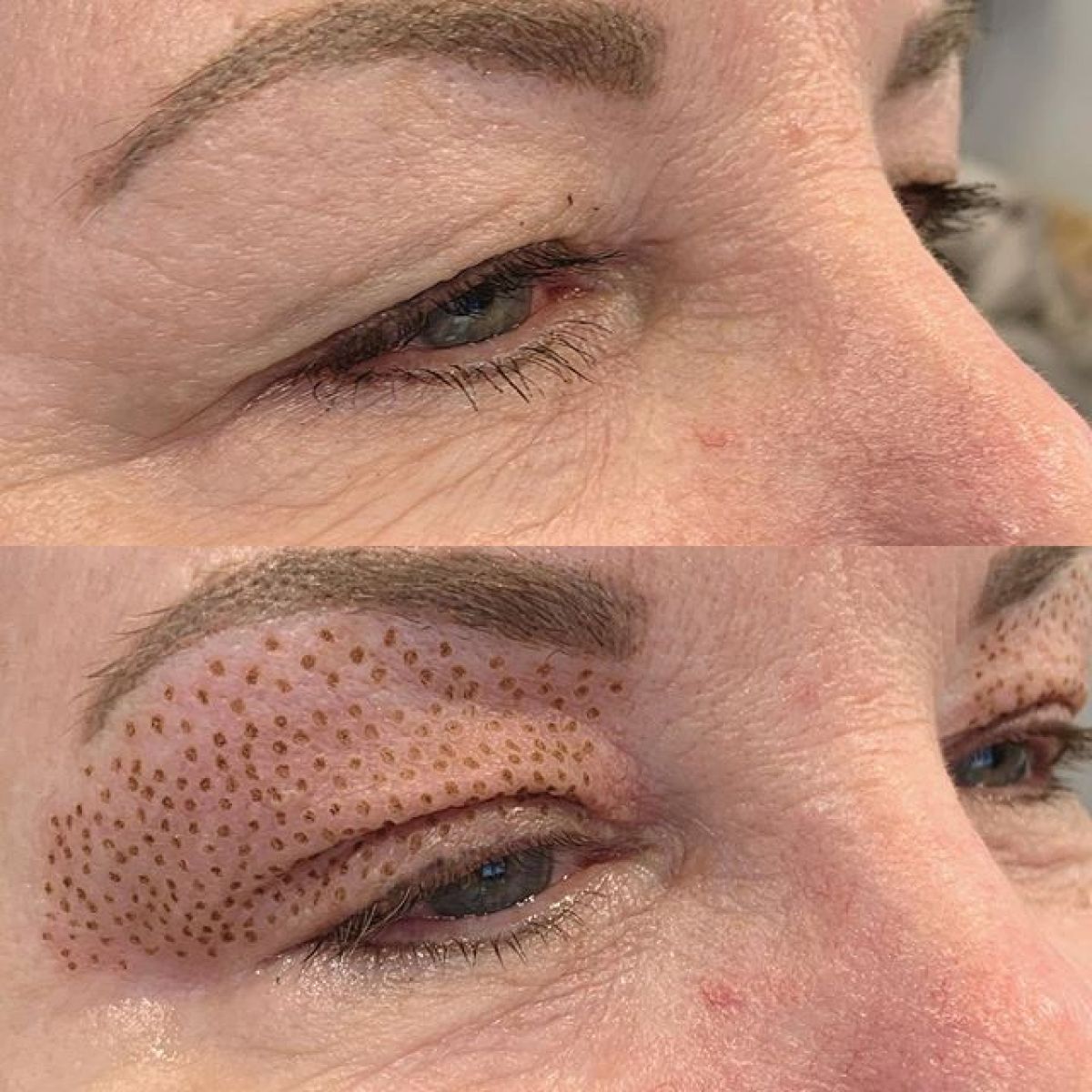 Plasma lift à Muret (31) Par Deborah - Estheca
