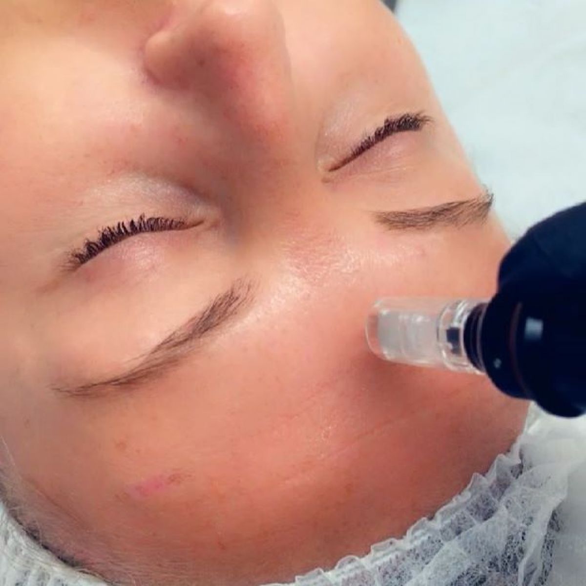 MicroNeedling BB Glow à Beausoleil (06) Par Inès - Estheca