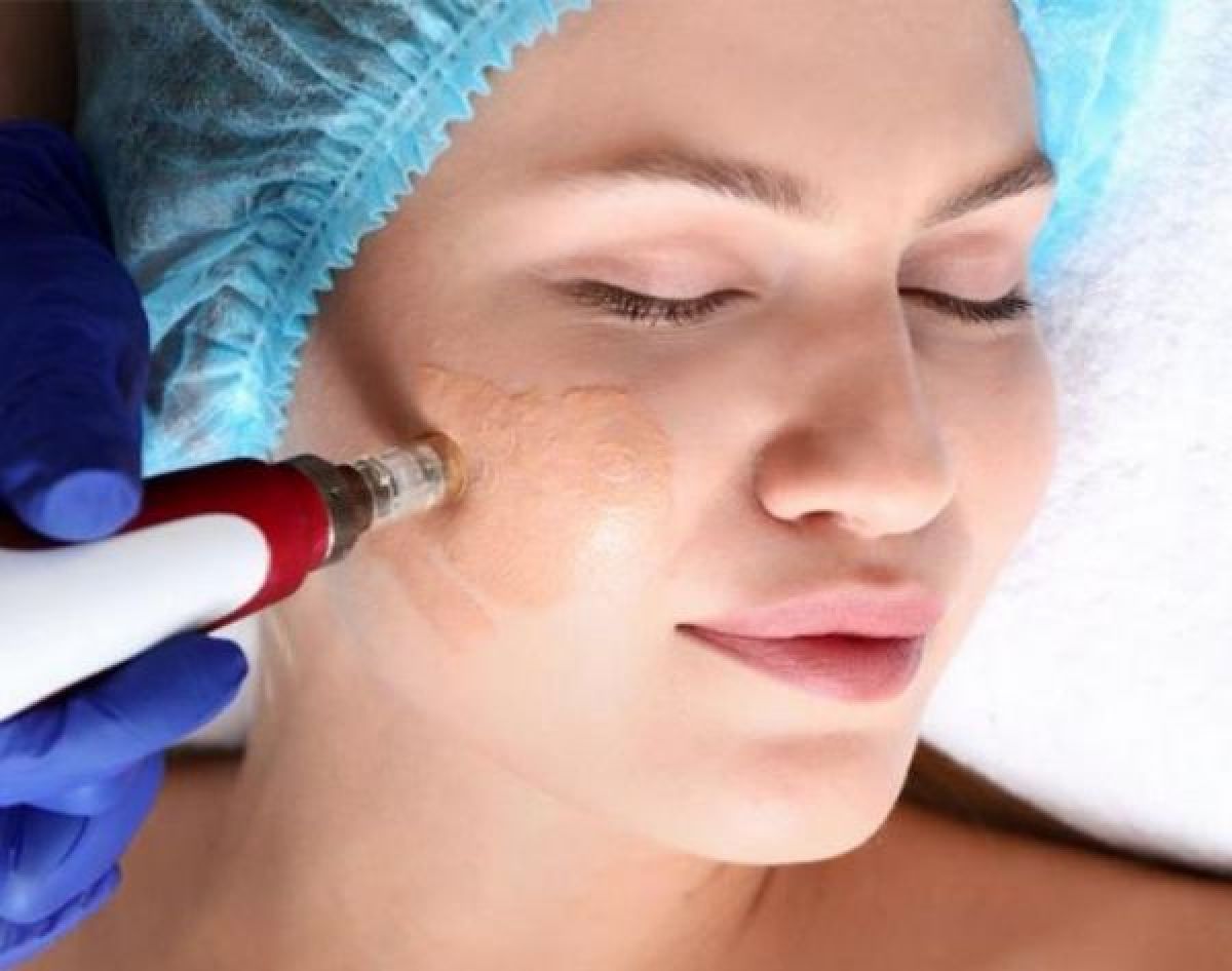 Microneedling BB GLOW à Bordeaux (33) Par Aude - Estheca