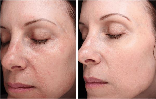 À Blois | Microneedling esthétique (traces d'acné, imperfections...) | Les meilleures esthéticiennes