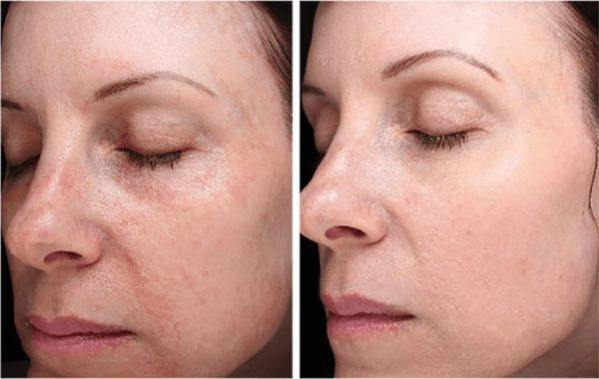 Microneedling esthétique (traces d'acné, imperfections...) à Blois (41) Par Ingrid - Estheca