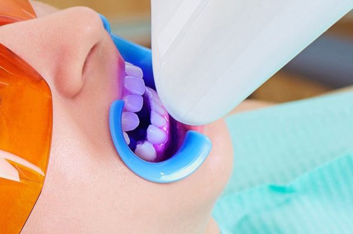 Blanchiment dentaire Professionnel à Noisy-le-Grand (93) Par Angélique - Estheca