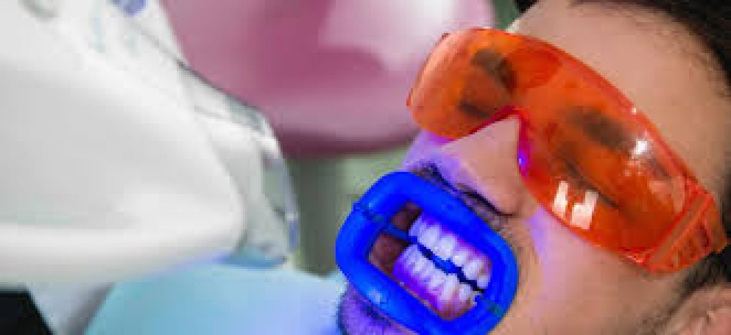 Blanchiment dentaire Pro à Plaisance-du-Touch (31) Par Mathilde - Estheca