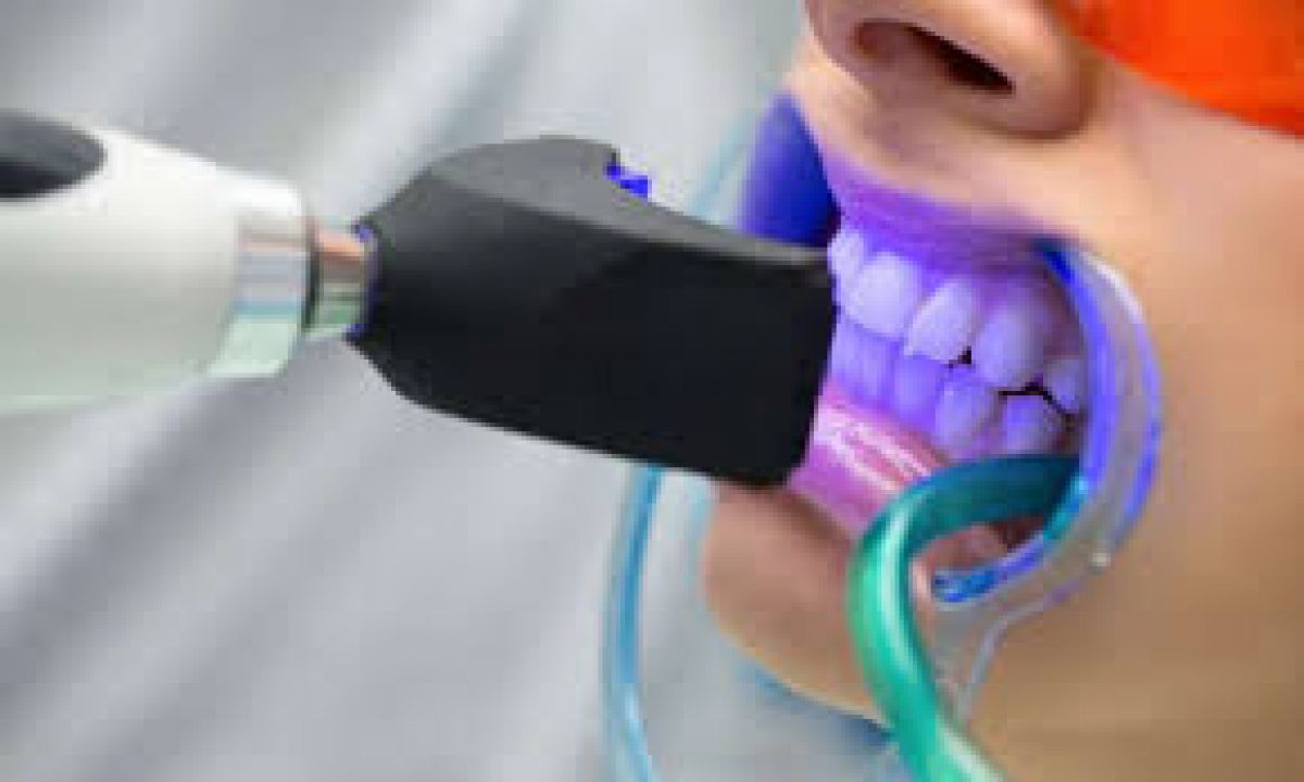 Blanchiment dentaire Professionnel à Neuilly-sur-Marne (93) Par Léa - Estheca