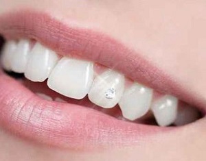 À Uckange | Strass Dentaire Swarovski | Les meilleures esthéticiennes