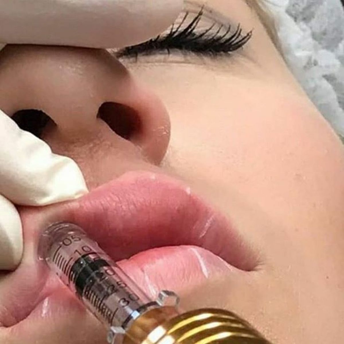 Hyaluron pen à La Penne-sur-Huveaune (13) Par Vanessa - Estheca