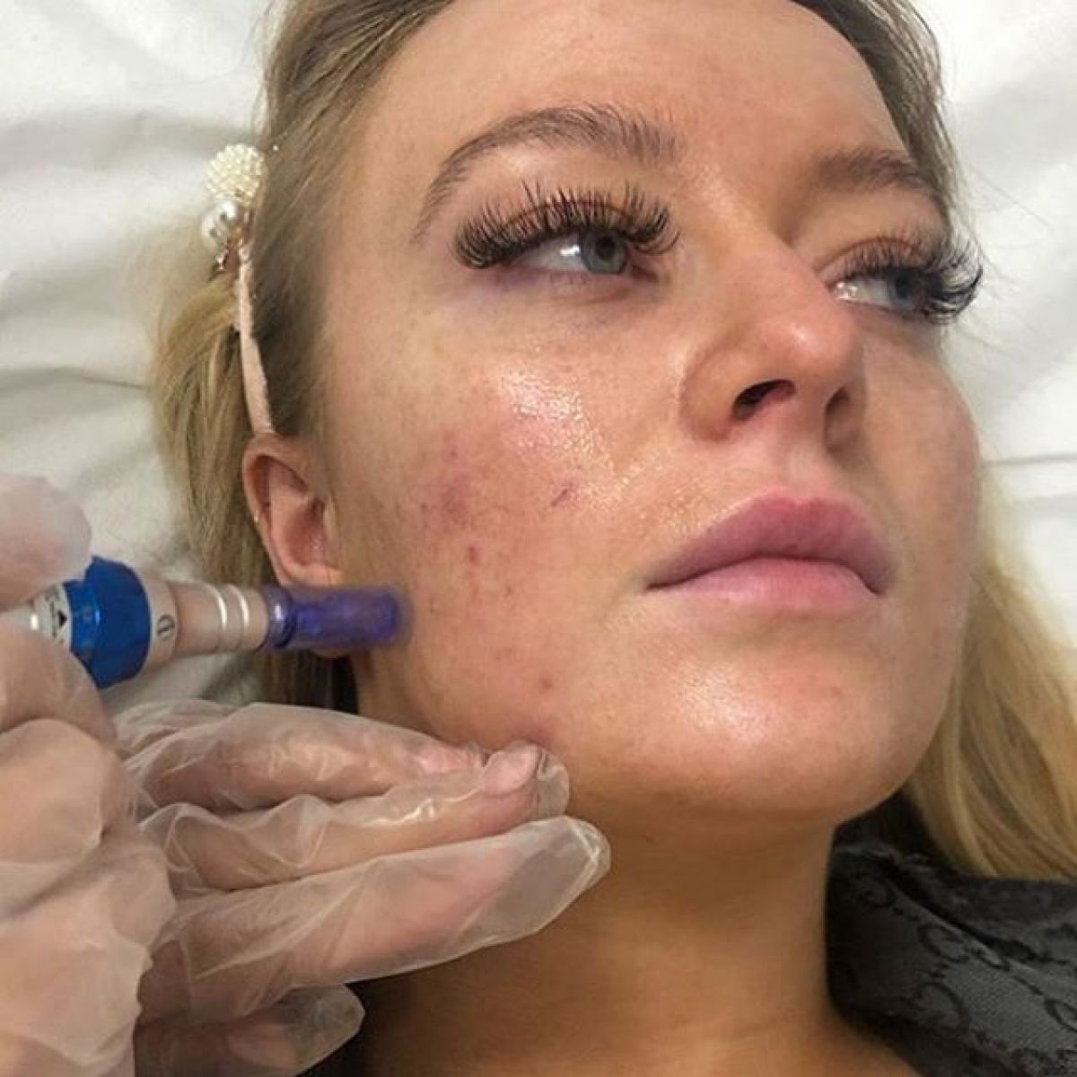 MicroNeedling BB Glow à Tremblay-en-France (93) Par Mélodie - Estheca