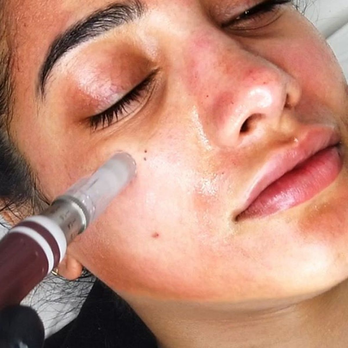 MicroNeedling BB Glow à Rosny-sous-Bois (93) Par Céline - Estheca