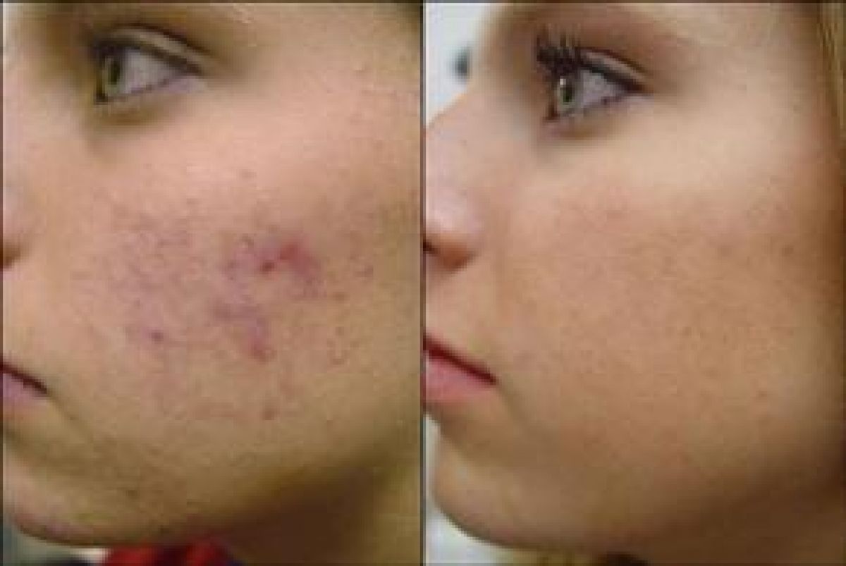 Microneedling/ BB glow à Valenciennes (59) Par Stacie - Estheca