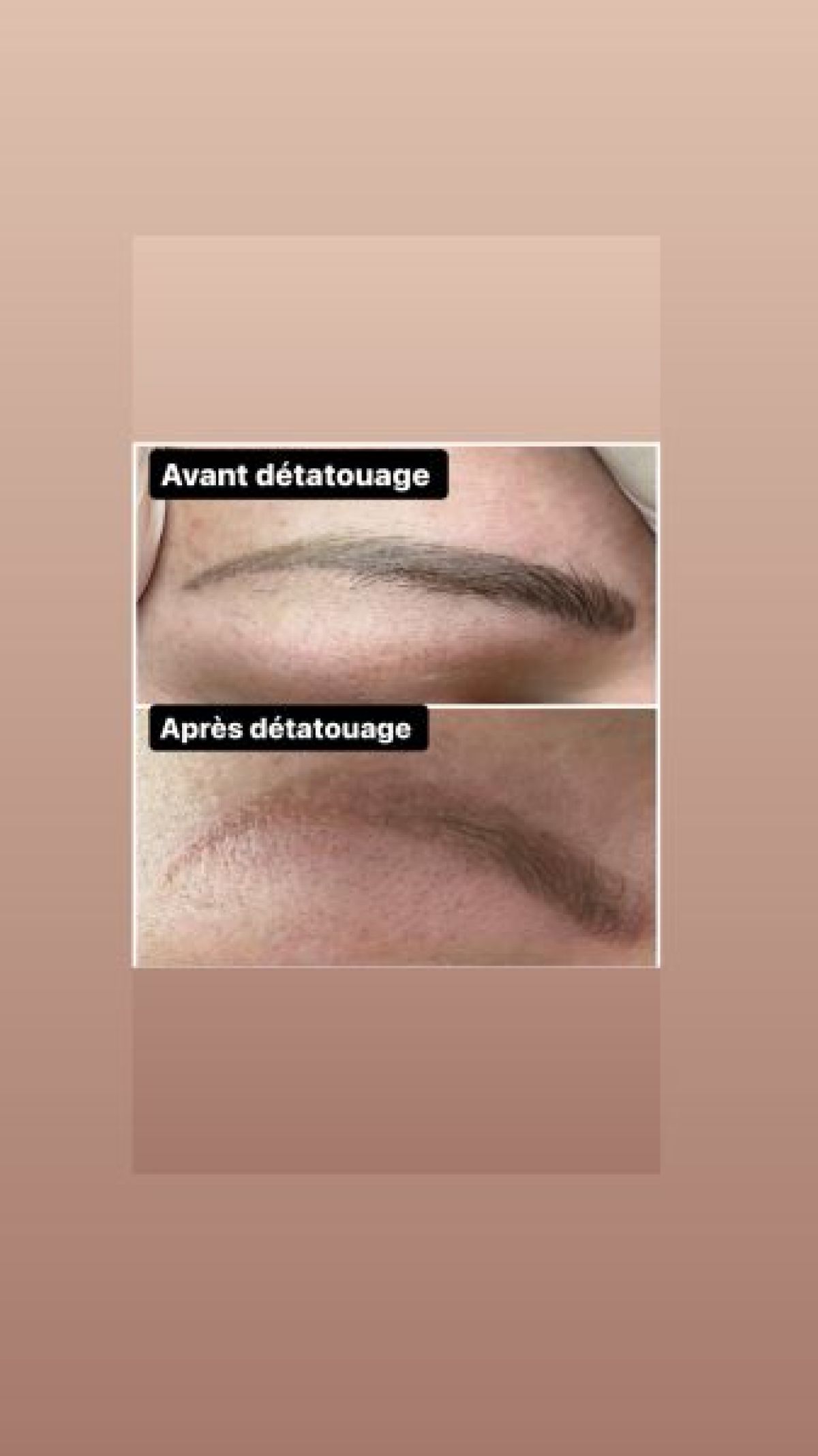 Détatouage à Perpignan (66) Par Clémence - Estheca